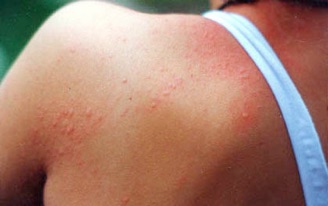 Red Itchy Bumps on Skin: Remedies, Treatment for Small Red ...